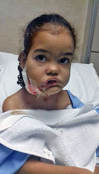 Врачи удалили с лица трехлетней девочки опухоль массой болье двух килограмм