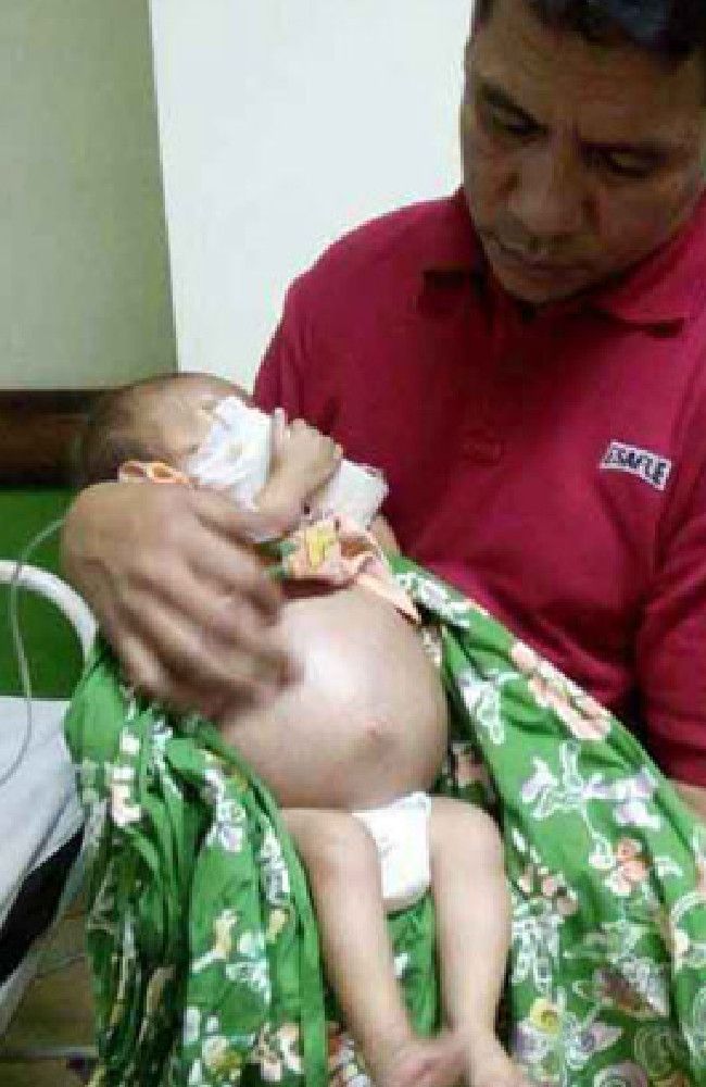 Хирурги обнаружили внутри младенца близнеца-паразита