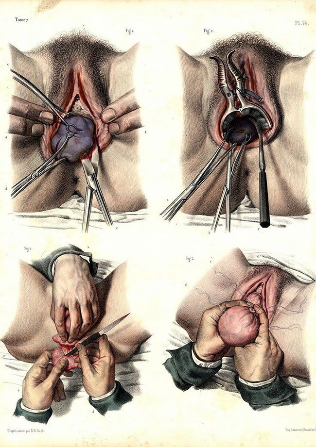 Жуткие реалистичные картинки медицинских процедур начала XIX века