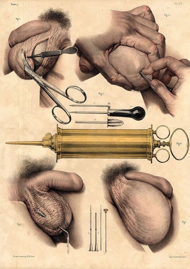Жуткие реалистичные картинки медицинских процедур начала XIX века