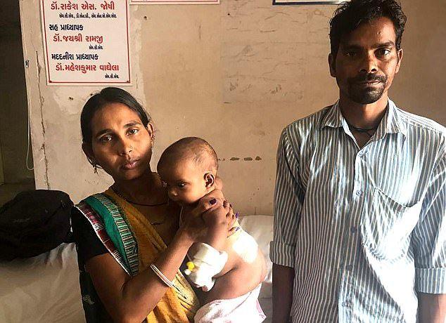 В Индии хирурги ампутировали четвероногой девочке лишние конечности