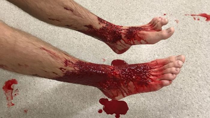 Неизвестные существа искусали ноги австралийского подростка
