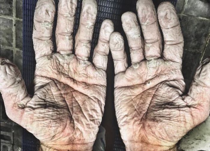 Руки гребца Алекса Грегори после 1000-километрового полярного похода
