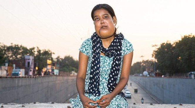 У 17-летней девушки из Индии сильнейшая опухоль лица