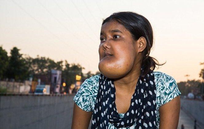 У 17-летней девушки из Индии сильнейшая опухоль лица