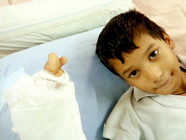 Индийскому мальчику пересадили пальцы ног на руку