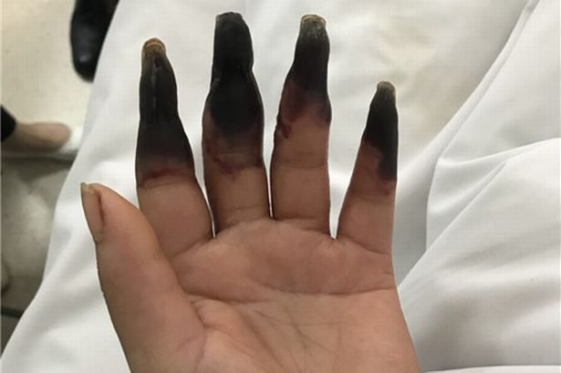 Женщина порезалась во время уборки, и у нее сгнили восемь пальцев