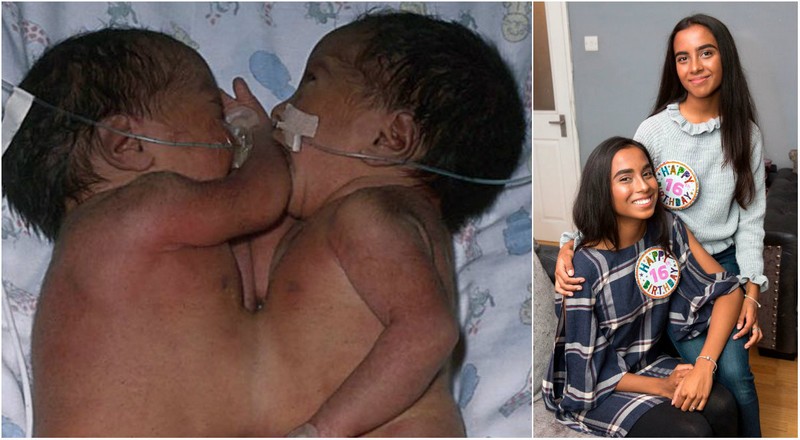 Разделённые сиамские близнецы спустя 16 лет