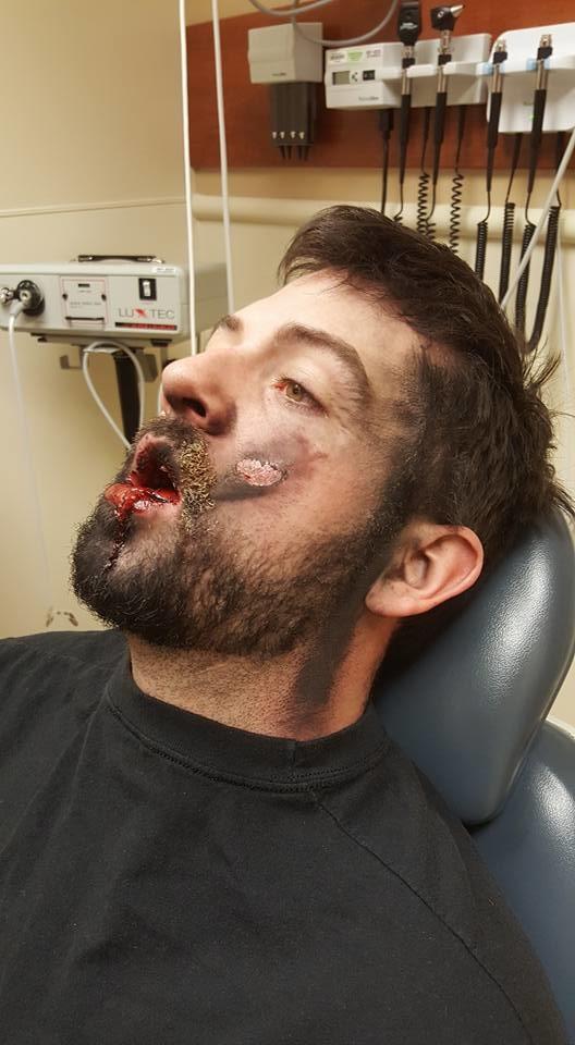 Он закурил электронную сигарету — и тут же потерял 7 зубов