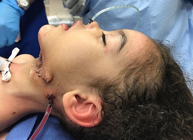 Врачи удалили с лица трехлетней девочки опухоль массой болье двух килограмм