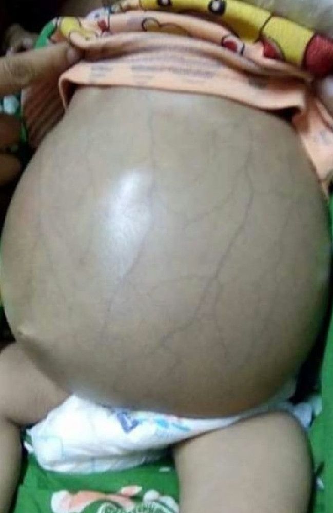 Близнец-паразит «пожирал» младенца, врачи провели уникальную операцию: фото