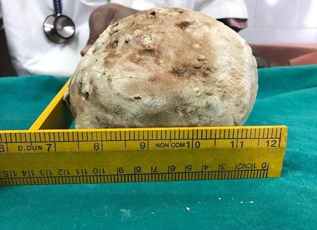 Хирурги извлекли из мочевого пузыря пациента огромный камень