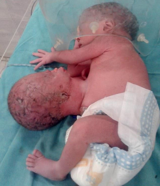 Индийский младенец родился со второй головой на животе