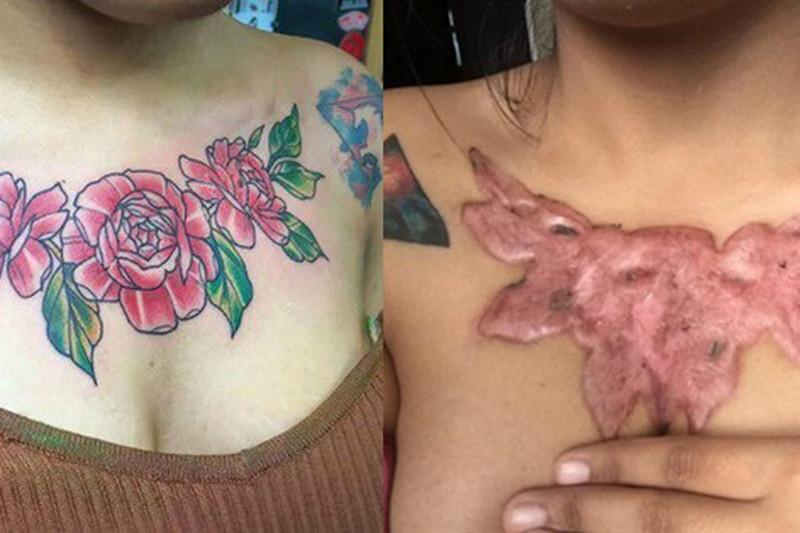 Последствия неудачного выведения татуировки