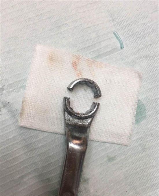 Стоматологи бормашиной срезали гаечный ключ с распухшего члена китайца