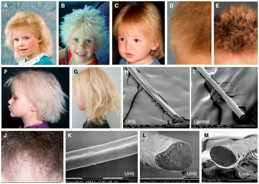 Синдром нерасчесываемых волос