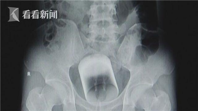 Пациент отказался объяснять врачам, откуда в его заднице взялся стакан