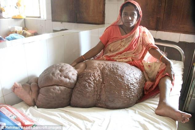 У женщины из Бангладеш нога размером и весом с подростка