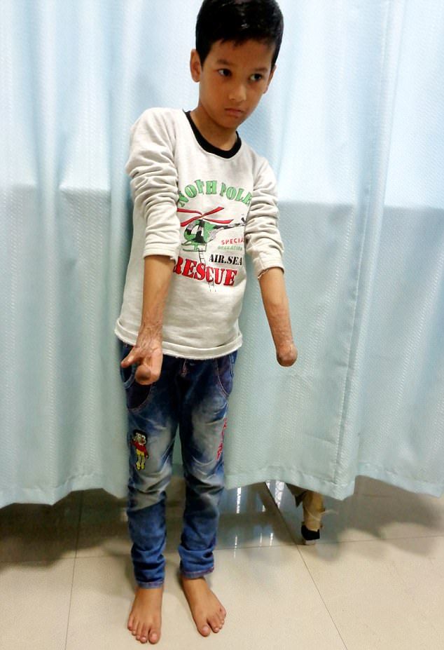 Индийскому мальчику пересадили пальцы ног на руку
