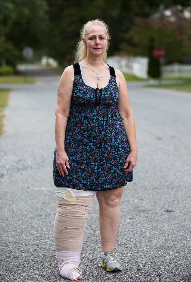 Из-за проблем с лимфатической системой нога американки раздулась в три раза