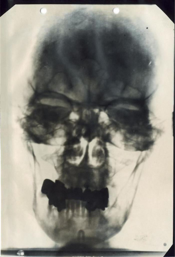 Рентгеновский снимок Адольфа Гитлера, 1944 год, Великогерманская Империя