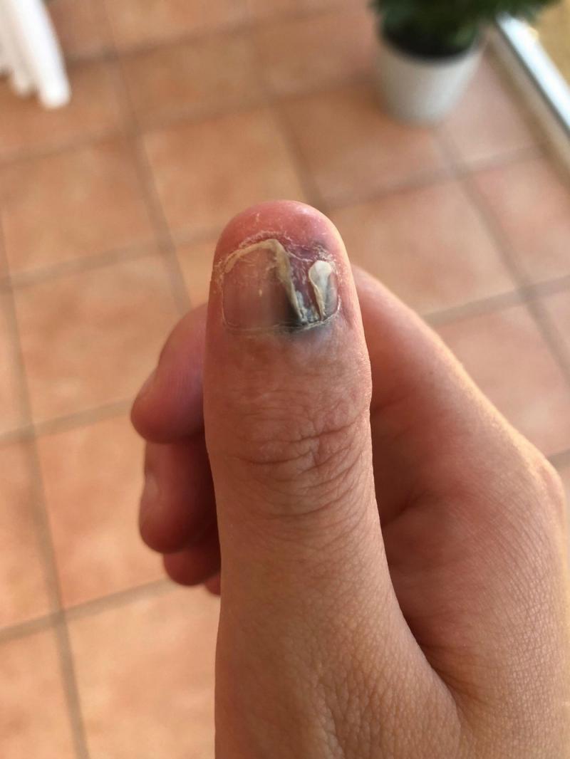Девушке пришлось ампутировать палец из-за привычки грызть ногти