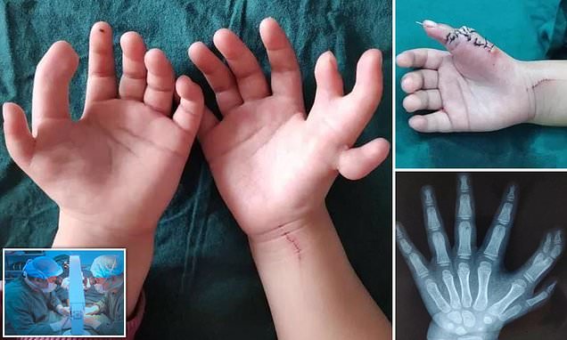 В Китае прооперировали девочку с 14 пальцами