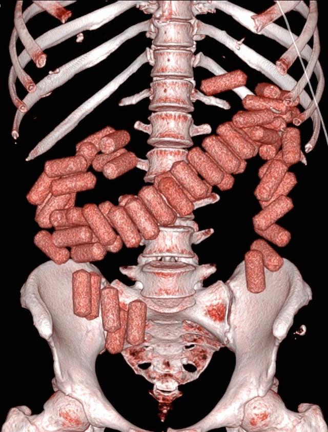 3D реконструкция томографии брюшной полости контрабандиста кокаина