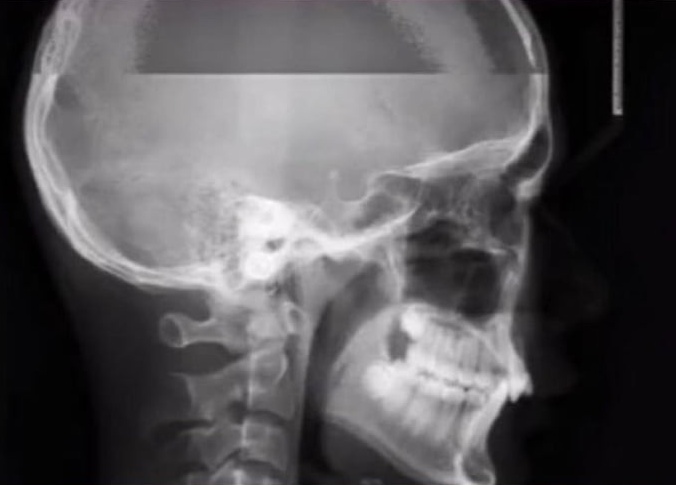 Как будет выглядеть рентген, если вы чихнете в самый неподходящий момент