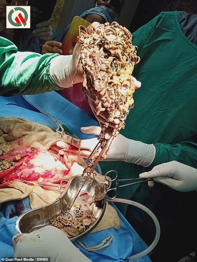 Хирурги извлекли из желудка женщины 1,5 кг ювелирных украшений и монет