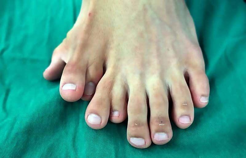 К хирургам обратился парень с 9 пальцами на ноге