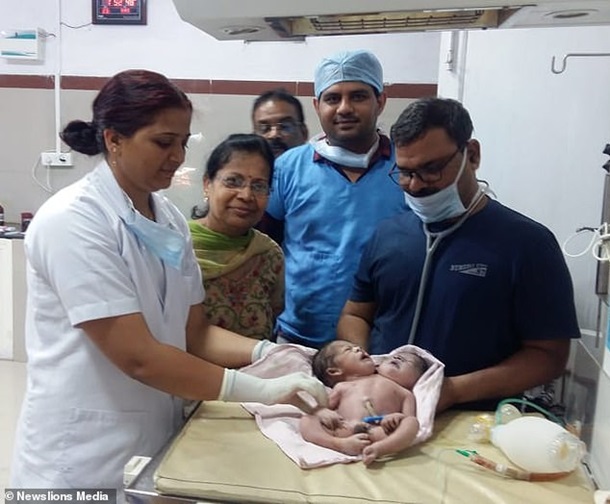 В Индии родился двухголовый и трехрукий ребенок