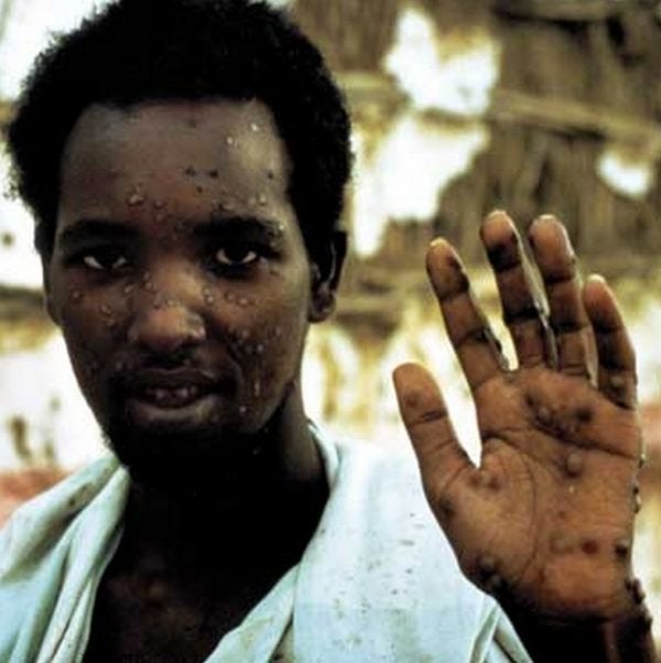 Али Маяу Маалин — последний больной натуральной оспой на Земле, 1977 год, Сомали