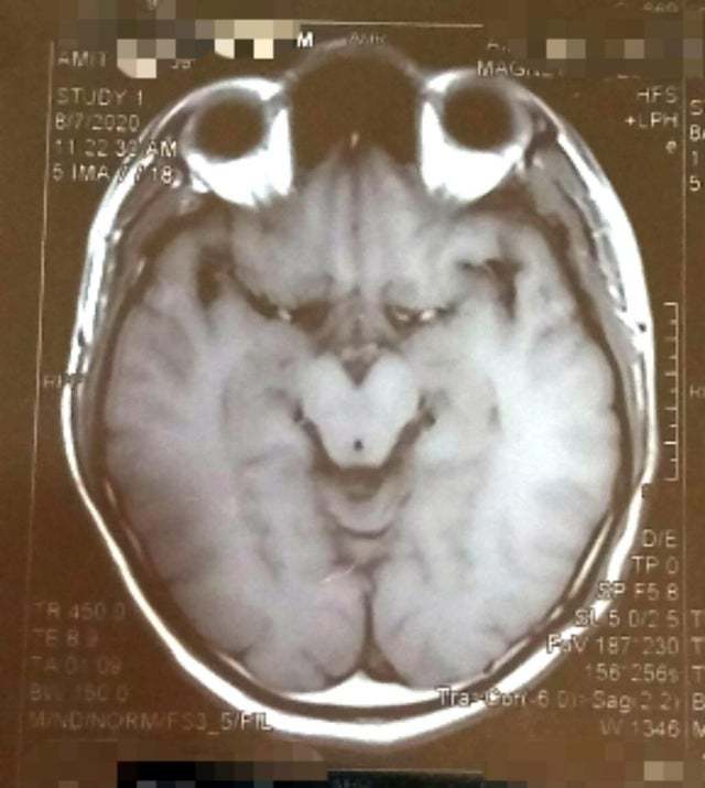 "МРТ моего мозга выглядит, как Гринч"