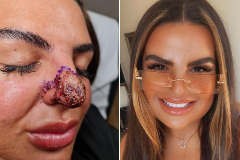 После похода к косметологу девушка чуть не лишилась носа и губы