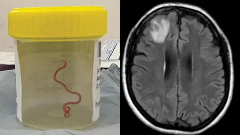 Впервые в мире в мозгу женщины нашли живого червя: какие симптомы у нее были