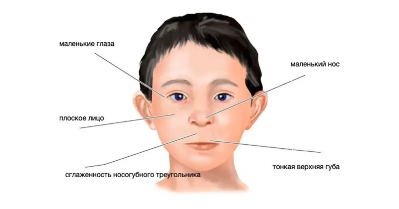 Что такое фетальный алкогольный синдром?