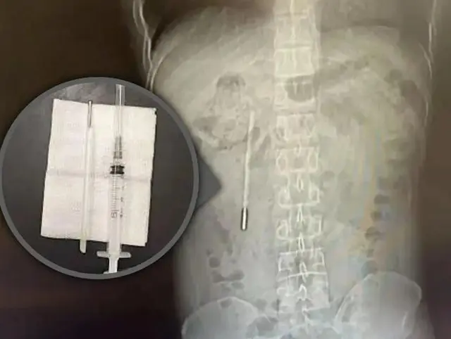 Китаец случайно носил термометр в кишечнике 20 лет